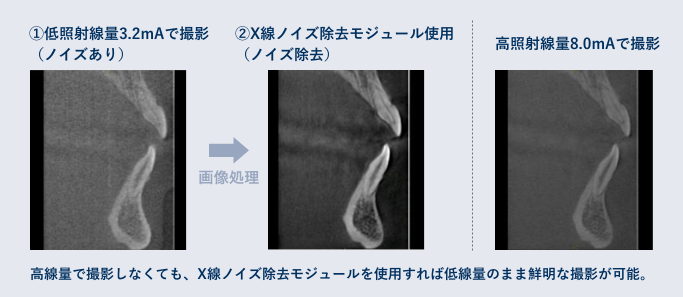 X線ノイズ除去モジュール